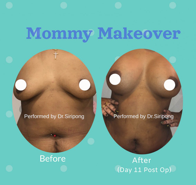 Slider image (4) Dr. Siripong Plastic Surgery in Thailand